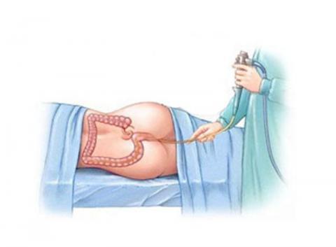 Basti (Medicated Enema Therapy)